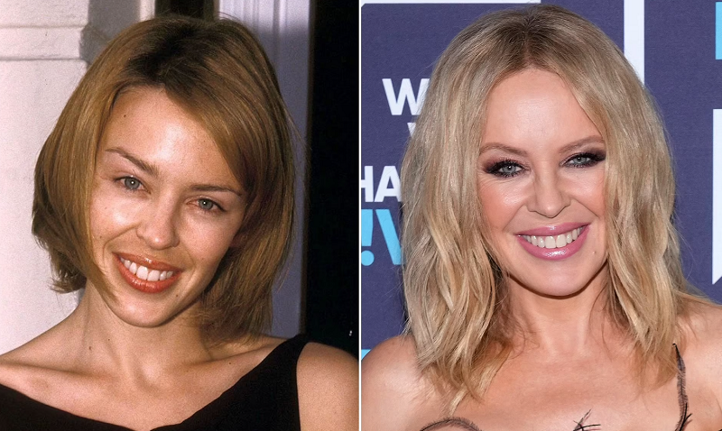 Has Kylie Minogue had Plastic Surgery